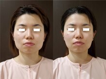 ソイズ 上中居店(SOIS)/小顔コルギ