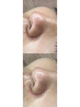 リノ沼津(Lino)/ララピールに&光エステ毛穴改善