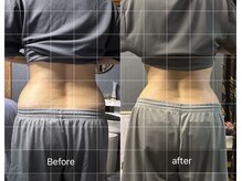 エルビタ(Elvita)/脂肪冷却（週一×32回、腹部）