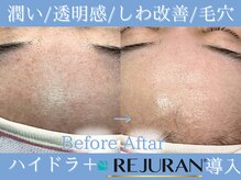 Cスキンケアクリニック 麻布店/ハイドラ毛穴＋リジュラン導入