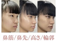 ラプリシュシュ 岡山店(Raplit)/隆鼻＋輪郭矯正40分30回