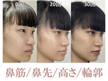 ラプリシュシュ 岡山店(Raplit)/隆鼻+輪郭矯正40分30回