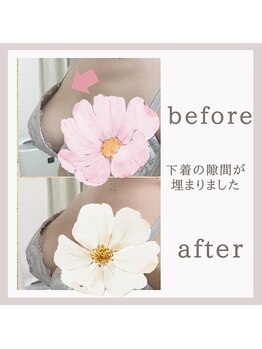 アリサナ(Arisana)/症例写真　バスト　葛西