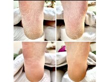 ネイルサロン ブリエ(briller)の雰囲気（踵の角質ケア）