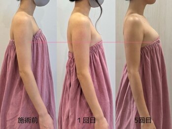 ロココ 岐阜店(Rococo)の写真/【夏に差がつく】二の腕・ハミ肉をバストへ!姿勢から整える本格サイズアップで、後ろ姿まで美しいラインへ