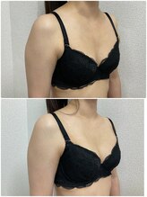 バーディー(BIRDIE)/施術１回/2０代