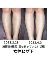 美意識/両脚脱毛　4,500円