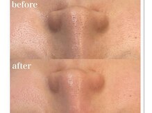 ボディベルム(BODY BELM)/お鼻の汚れOFF