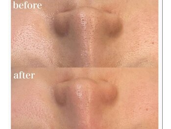 ボディベルム(BODY BELM)/お鼻の汚れOFF