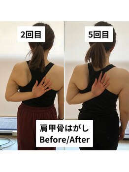 べっぷ餅ヶ浜整体院/肩甲骨はがしbefore/after