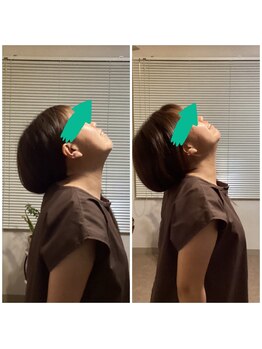 エクステンド鍼灸整体院(extend鍼灸整体院)/施術後 鍼