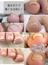 ティーラ ネイル(Thira nail) 巻き爪ケア Nailtrim