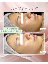 ソユ(SOYOU)/施術* 　ハーブピーリング