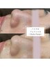 【毛穴洗浄×リフトアップ】ハイドロフェイシャル¥14,000→¥10000