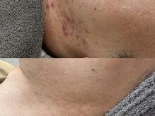 フォア(foi)/ハーブピーリング