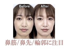 ラプリ 盛岡店(Raplit)/隆鼻＋輪郭矯正40分10回