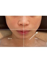 アリュール(Allure)/美肌と小顔に★