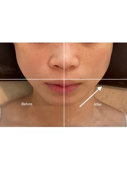 アリュール(Allure)/美肌と小顔に★