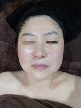 ボーソリューション(Beau-Solution)/【50代　まるで糸リフト】