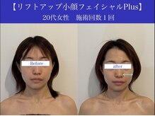 リプロ(RePro)/20代　ビフォーアフター