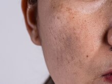 アンドアンド(&and)/種類を見極めてシミケア◎