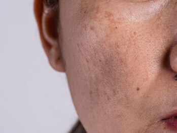 アンドアンド(&and)/種類を見極めてシミケア◎