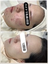RINFACEといえば『ヒト歯髄(乳歯)幹細胞』それって何？！