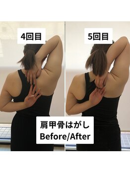 べっぷ餅ヶ浜整体院/肩甲骨はがしbefore/after