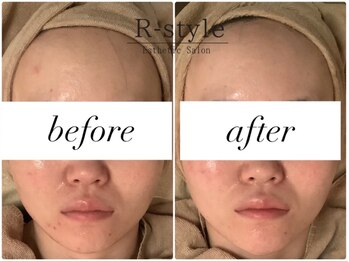 エステサロン アールスタイル(R-style)/ハーブピーリング+プラズマ