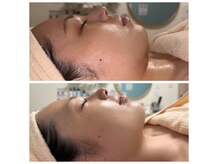 アリュメント(Allument)の雰囲気(【レモンボトル・レッドショット脂肪分解】2回の効果)