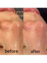 ソアン(Soin)/毛穴引き締め