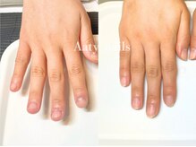 アーティネイルズ(Aaty Nails)/【深爪矯正】ハンド