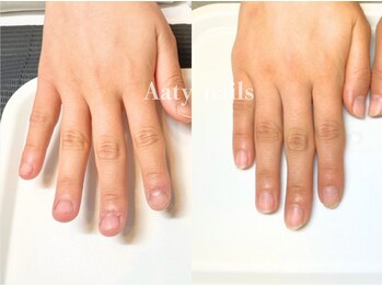 【深爪矯正】ハンド