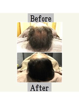 ペールノエル 富士店(PERENOEL)/育毛促進(40代男性)