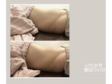 ビューティーサロン アール(R)/痩身マシーンお腹