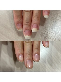 自爪育成ケアコース