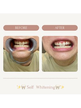 サロンエピ(Salon Epi)/セルフホワイトニング/烏丸御池