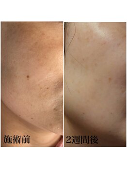 ヴィアージュ(Viage)/シミケア