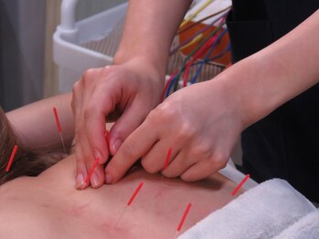 エムフロート(M float)/美容鍼