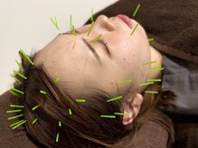 ひめじ鍼灸整骨院の雰囲気（リフトアップ、ターンオーバーの促進を行います。小顔/疲れ目）