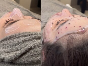 マウ(Mau)の写真/毛穴の開き、黒ずみ、凸凹…お肌悩みに特化！TIPハーブピーリングでつるんとなめらか陶器肌に♪