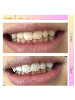 エクシアホワイトニング 都城店/ホワイトニングビフォーアフター