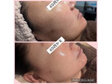 ウィズユー(with U)の雰囲気(40代シミ/しわ悩み/REVIハーブピーリング/ツヤ肌変化)