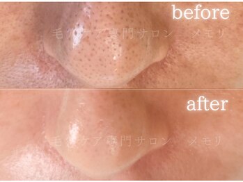 メモリ/お客様の変化/毛穴ケア