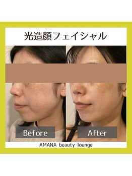 アマナ(AMANA)/ニキビ/たるみが気になる方へ