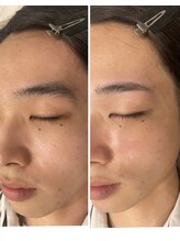 アカヌケ(AKANUKE)/メンズ美眉WAX脱毛