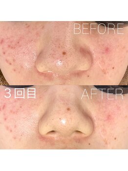 バーニー 梅田店(BARNEY)/ハーブピーリング