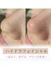 毛穴洗浄×ハイドラ《もうワンランク上の毛穴レスを♪》