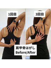 べっぷ餅ヶ浜整体院/肩甲骨はがしbefore/after