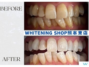 ホワイトニングショップ熊本東店/